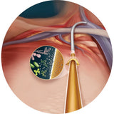 Palindrome™ Precision SI - Silver Ion Antimicrobial Sleeve Catheter Kit